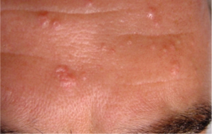 Xantelasma
