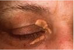 Xantelasma